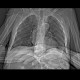 Skin folds, mimic of pneumothorax, PNO: CT - Computed tomography